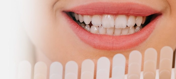 Tratamientos de blanqueamiento dental en verano